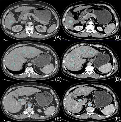 Computed tomography image quality in patients with primary hepatocellular carcinoma: intraindividual comparison of contrast agent concentrations